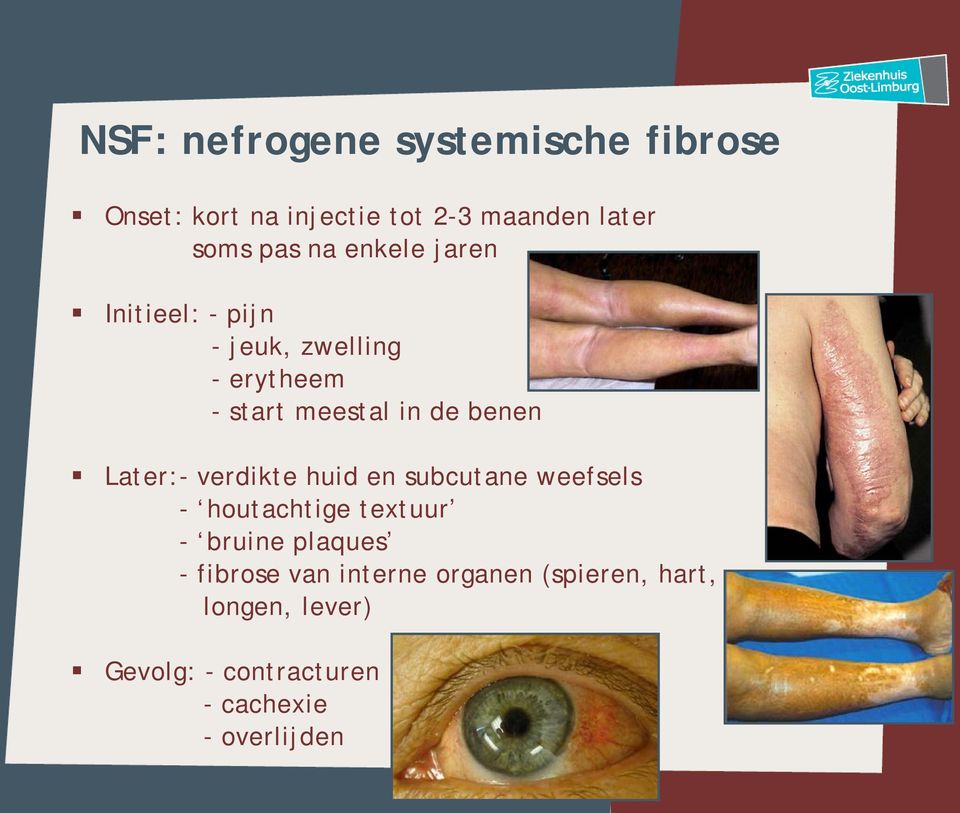 - verdikte huid en subcutane weefsels - houtachtige textuur - bruine plaques - fibrose van