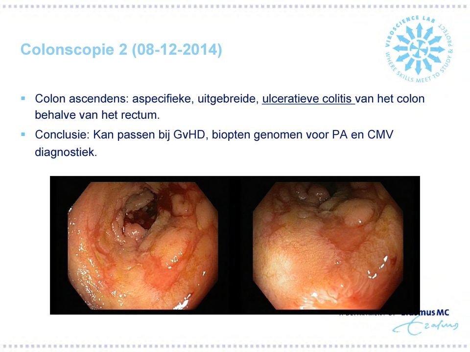 het colon behalve van het rectum.