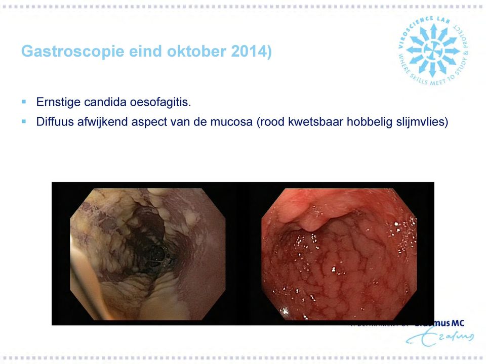 Diffuus afwijkend aspect van de