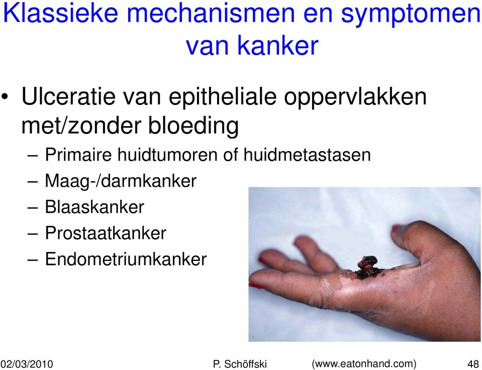 huidtumoren of huidmetastasen Maag-/darmkanker Blaaskanker