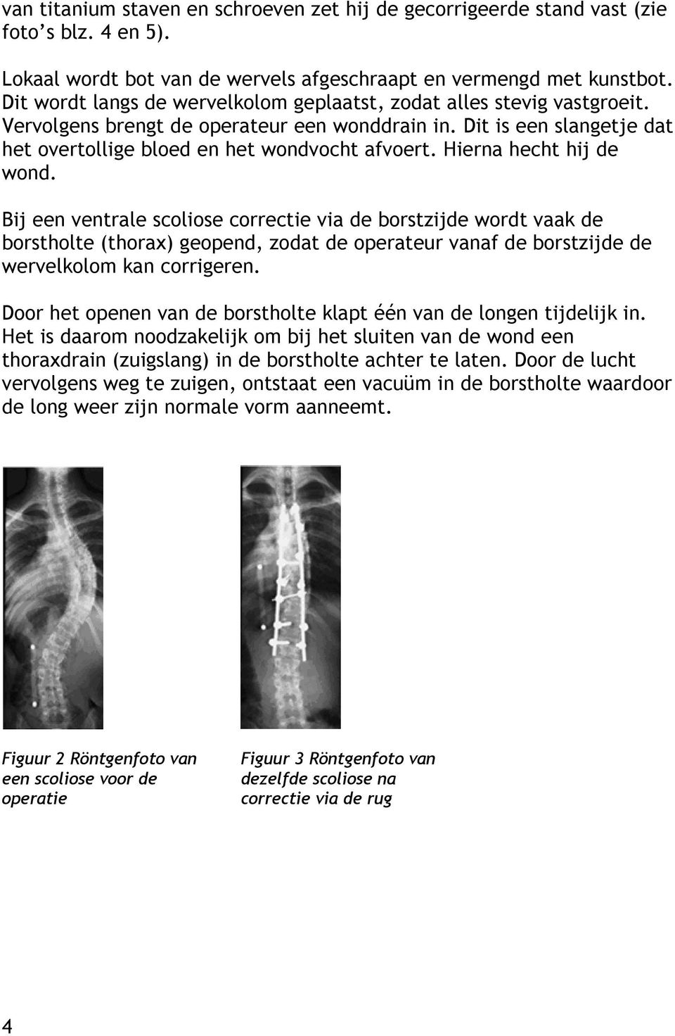 Hierna hecht hij de wond. Bij een ventrale scoliose correctie via de borstzijde wordt vaak de borstholte (thorax) geopend, zodat de operateur vanaf de borstzijde de wervelkolom kan corrigeren.