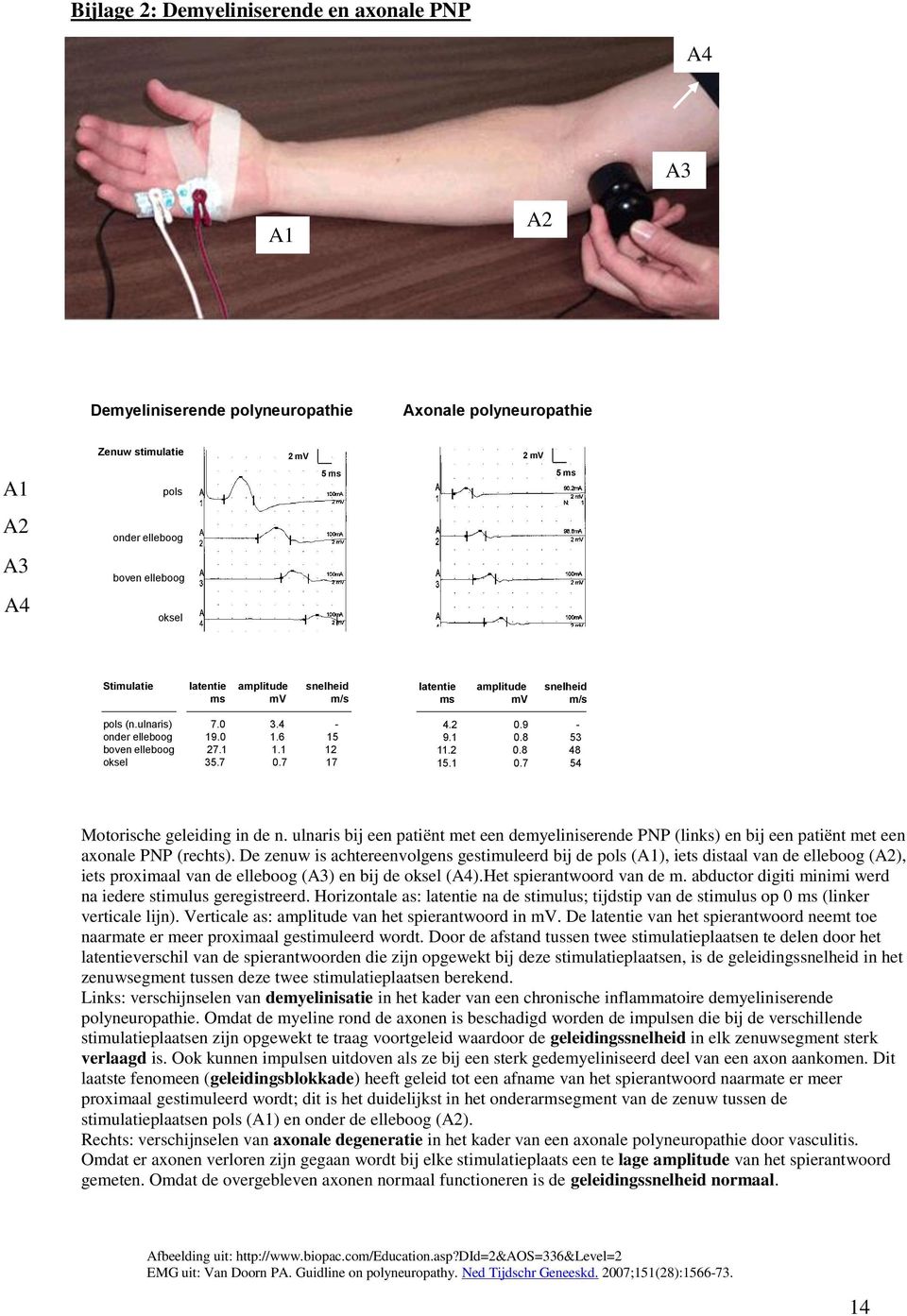 9-9.1 0.8 53 11.2 0.8 48 15.1 0.7 54 Motorische geleiding in de n. ulnaris bij een patiënt met een demyeliniserende PNP (links) en bij een patiënt met een axonale PNP (rechts).