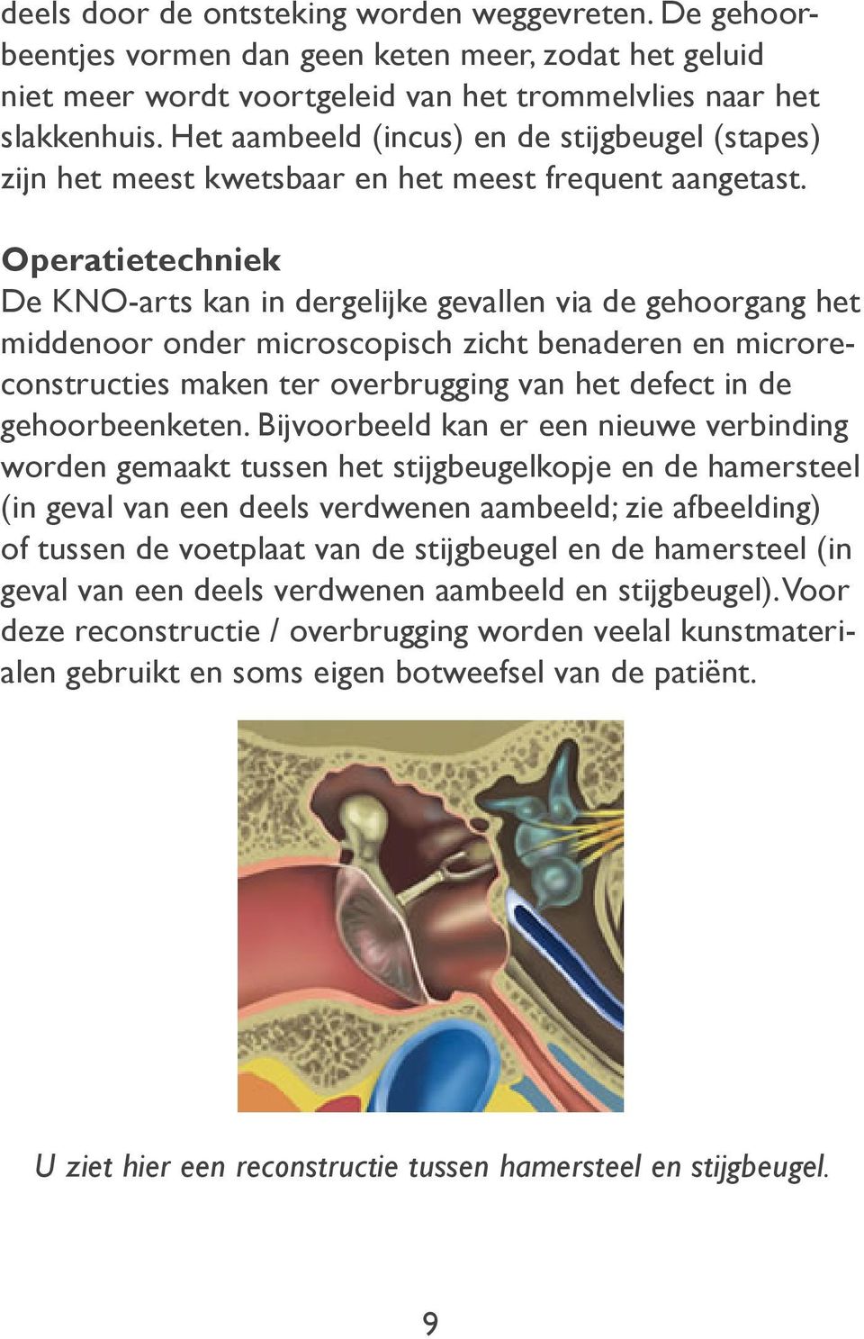 Operatietechniek De KNO-arts kan in dergelijke gevallen via de gehoorgang het middenoor onder microscopisch zicht benaderen en microreconstructies maken ter overbrugging van het defect in de