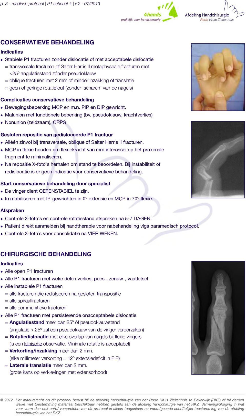 angulatiestand zónder pseudoklauw =oblique fracturen met 2 mm of minder inzakking of translatie =geen of geringe rotatiefout (zonder 'scharen' van de nagels) Complicaties conservatieve behandeling