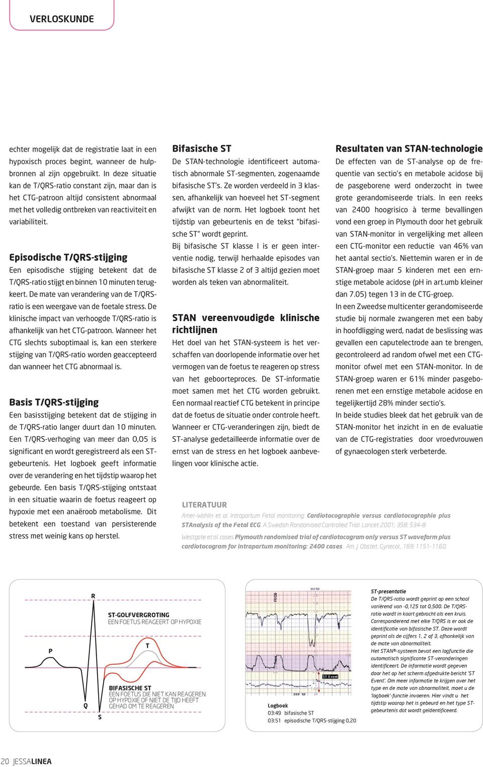 Episodische T/QRS-stijging Een episodische stijging betekent dat de T/QRS-ratio stijgt en binnen 10 minuten terugkeert. De mate van verandering van de T/QRSratio is een weergave van de foetale stress.