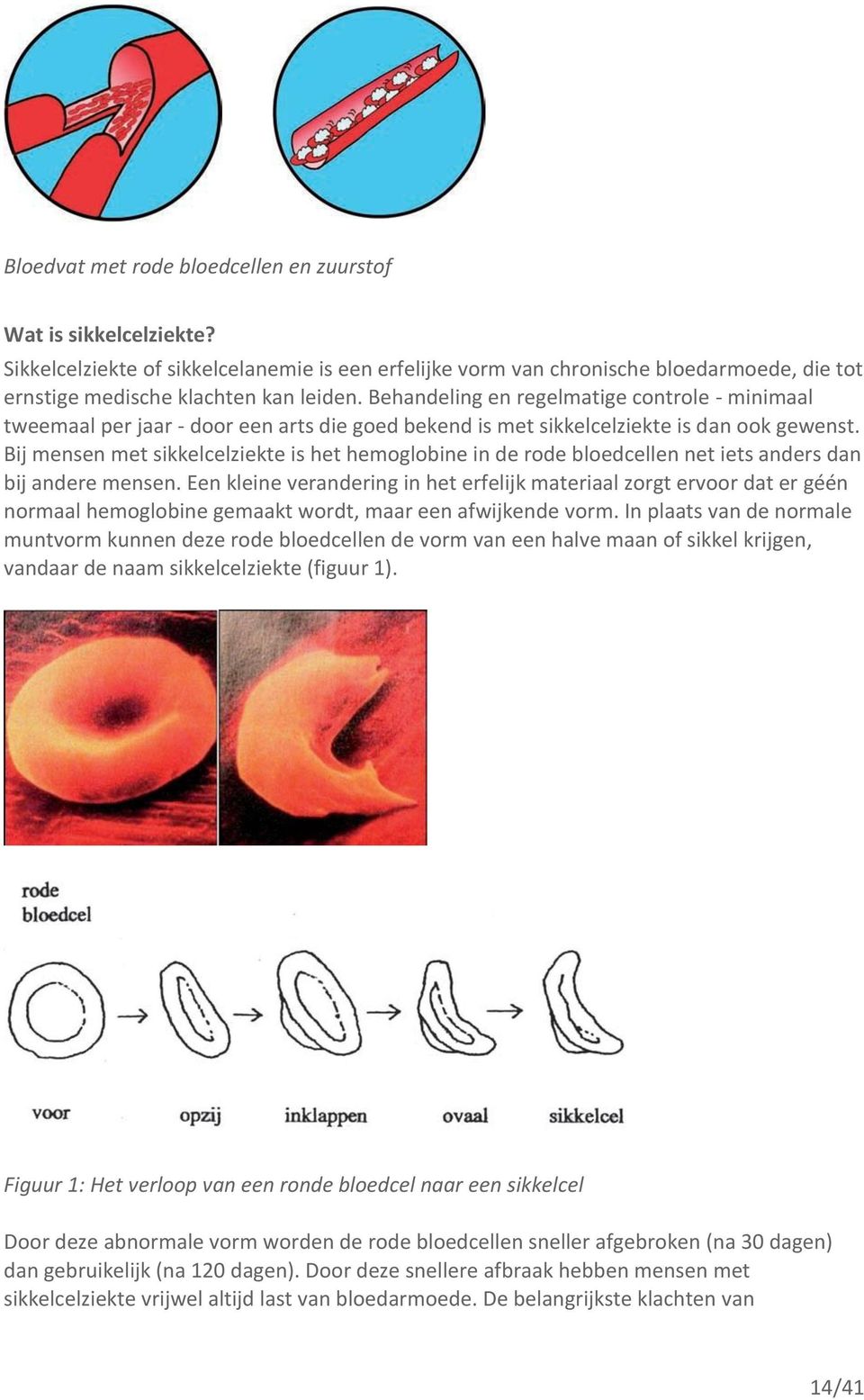 Bij mensen met sikkelcelziekte is het hemoglobine in de rode bloedcellen net iets anders dan bij andere mensen.