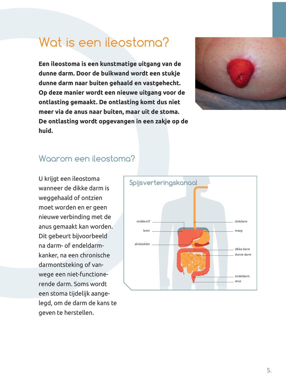 Waarom een ileostoma? U krijgt een ileostoma wanneer de dikke darm is weggehaald of ontzien moet worden en er geen nieuwe verbinding met de anus gemaakt kan worden.