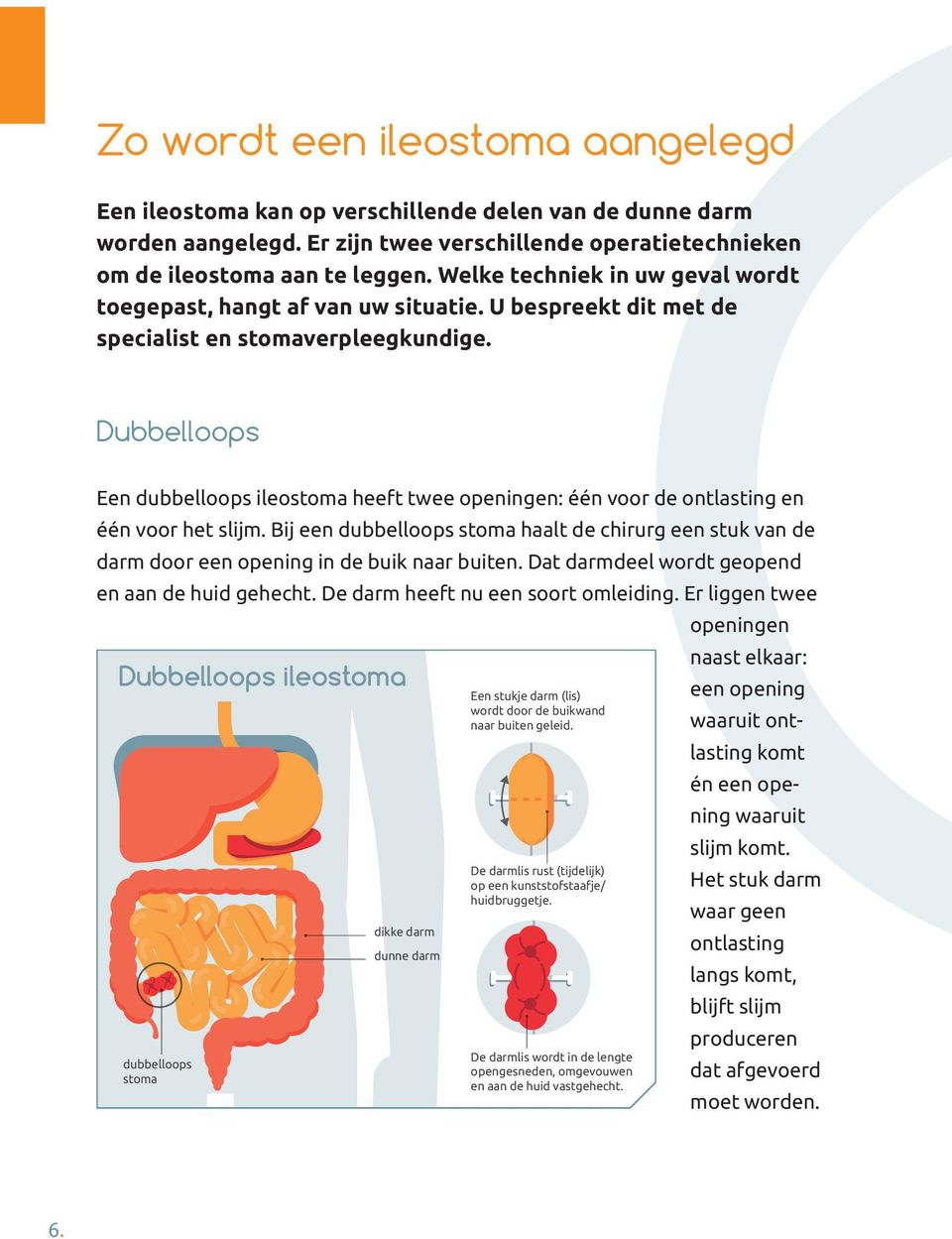 Dubbelloops Een dubbelloops ileostoma heeft twee openingen: één voor de ontlasting en één voor het slijm.