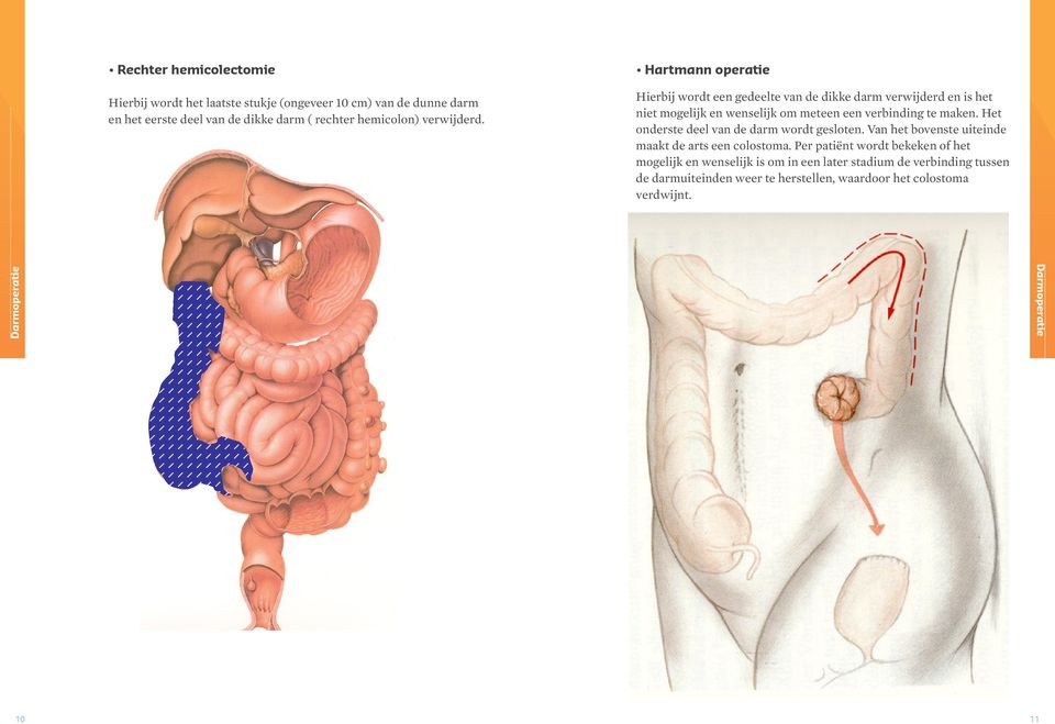 Het onderste deel van de darm wordt gesloten. Van het bovenste uiteinde maakt de arts een colostoma.