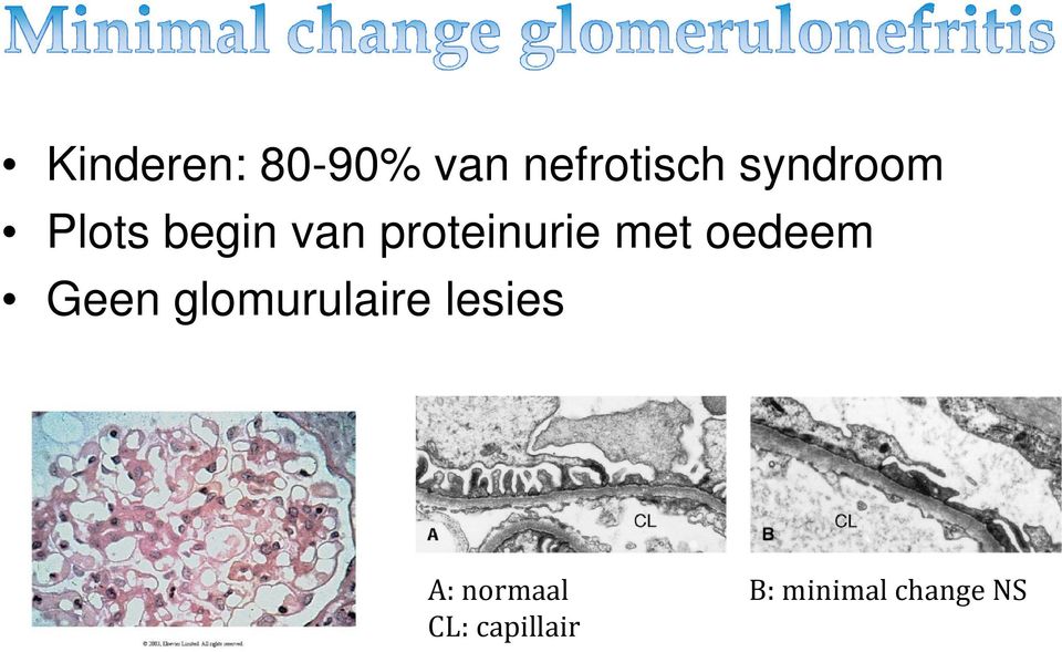 met oedeem Geen glomurulaire lesies