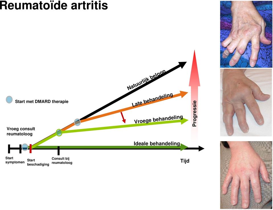 Vroege behandeling Progressie Ideale behandeling Start