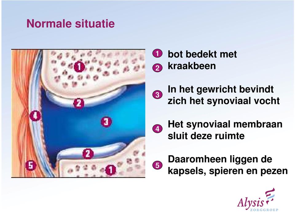 synoviaal vocht Het synoviaal membraan sluit