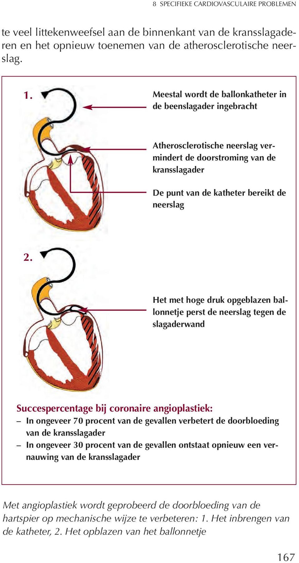 Het met hoge druk opgeblazen ballonnetje perst de neerslag tegen de slagaderwand Succespercentage bij coronaire angioplastiek: In ongeveer 70 procent van de gevallen verbetert de doorbloeding van de