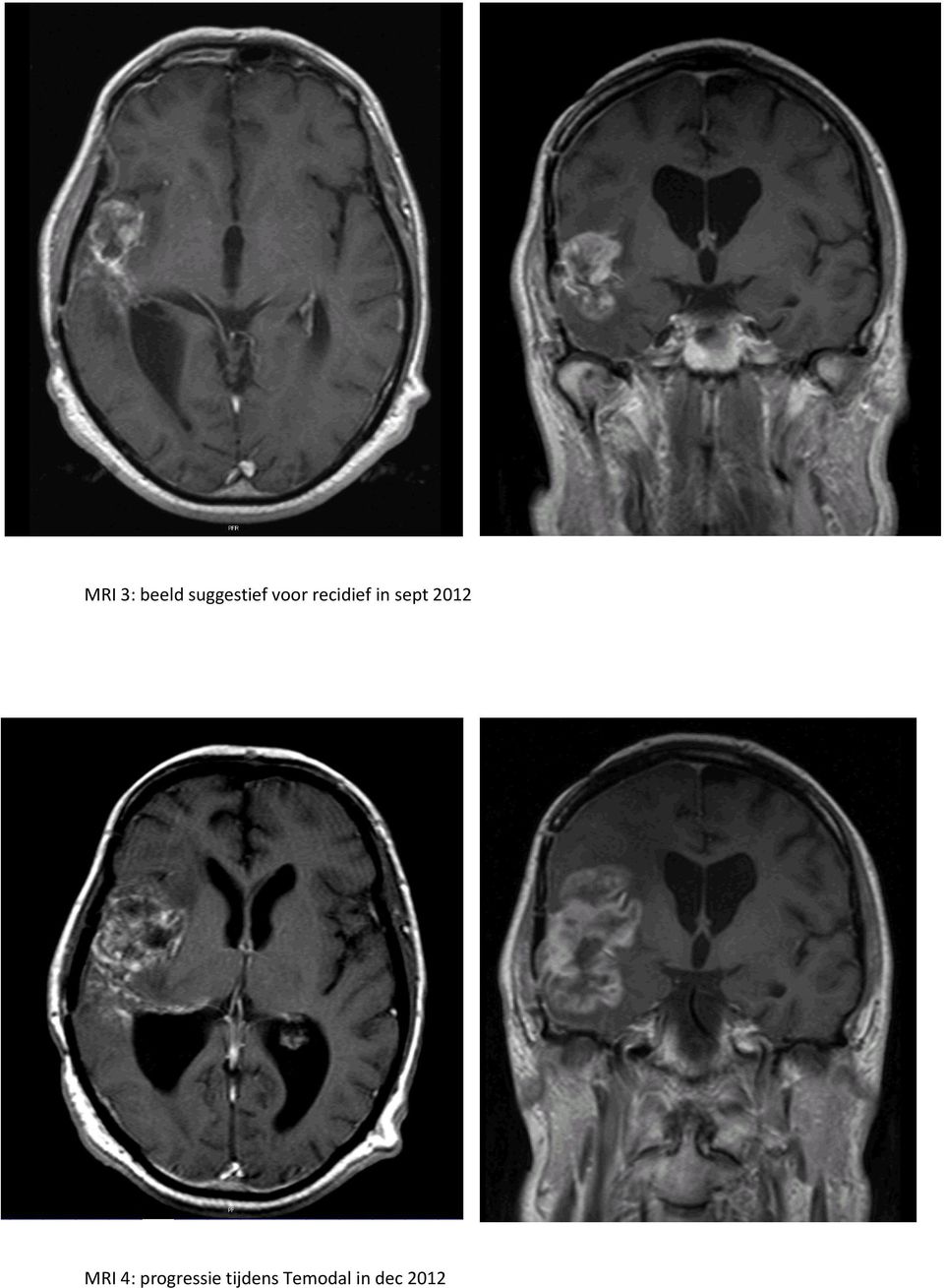 2012 MRI 4: progressie
