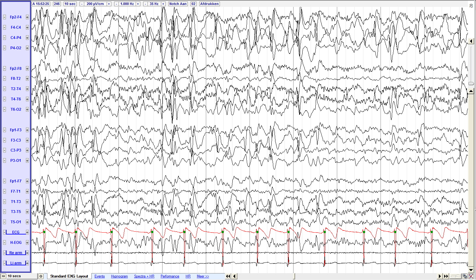 Slaap en epileptische storingen op het EEG