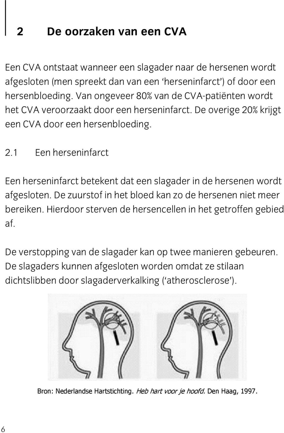 % krijgt een CVA door een hersenbloeding. 2.1 Een herseninfarct Een herseninfarct betekent dat een slagader in de hersenen wordt afgesloten.