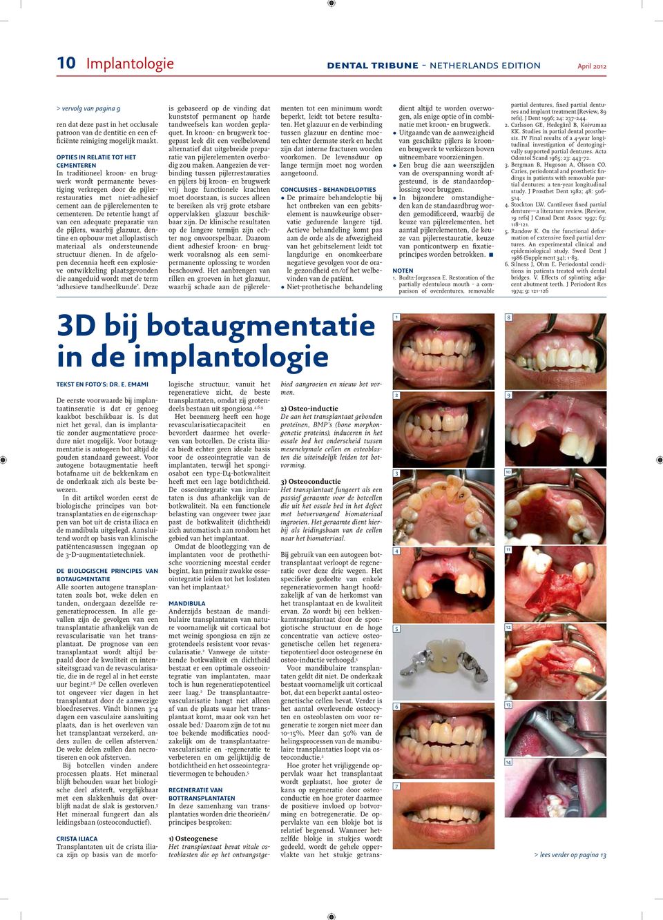 De retentie hangt af van een adequate preparatie van de pijlers, waarbij glazuur, dentine en opbouw met alloplastisch materiaal als ondersteunende structuur dienen.