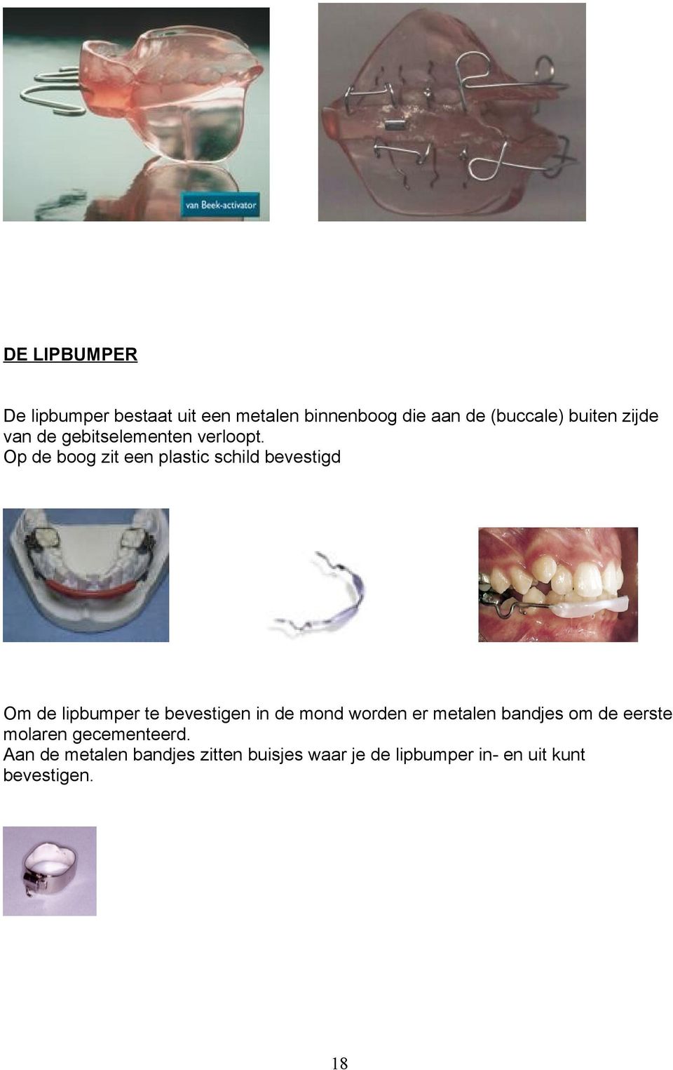 Op de boog zit een plastic schild bevestigd Om de lipbumper te bevestigen in de mond