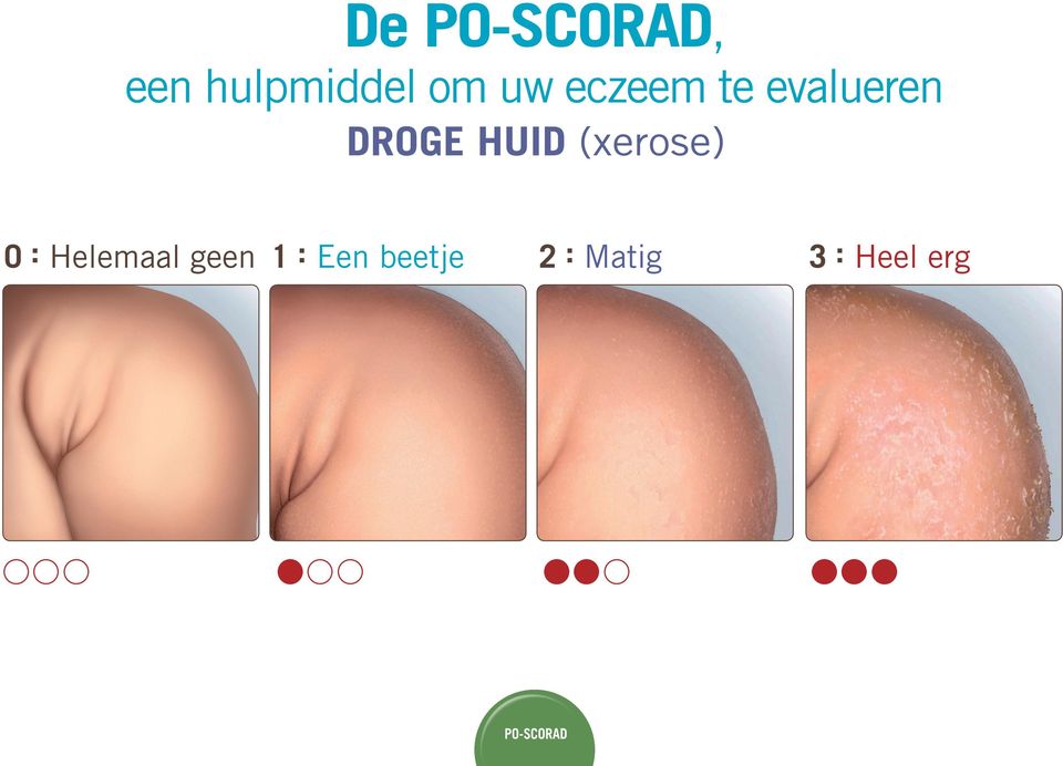 (xerose) 0 : Helemaal geen 1 :