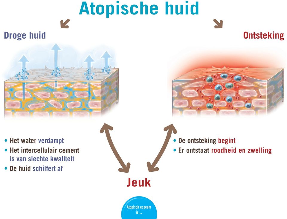 kwaliteit e huid schilfert af Jeuk e ontsteking