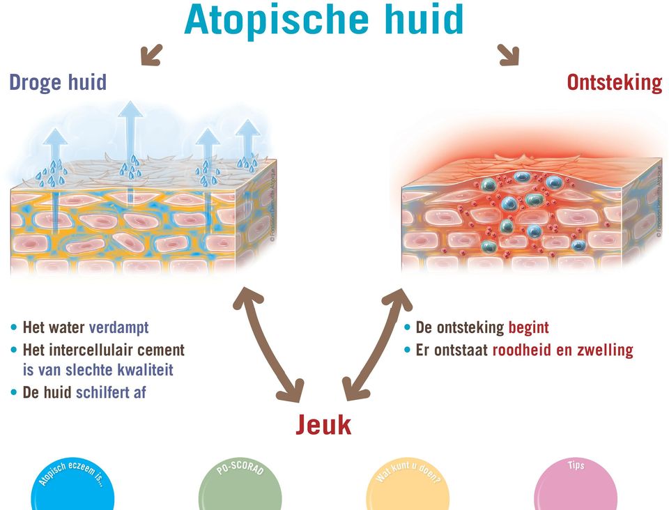 kwaliteit e huid schilfert af Jeuk e ontsteking