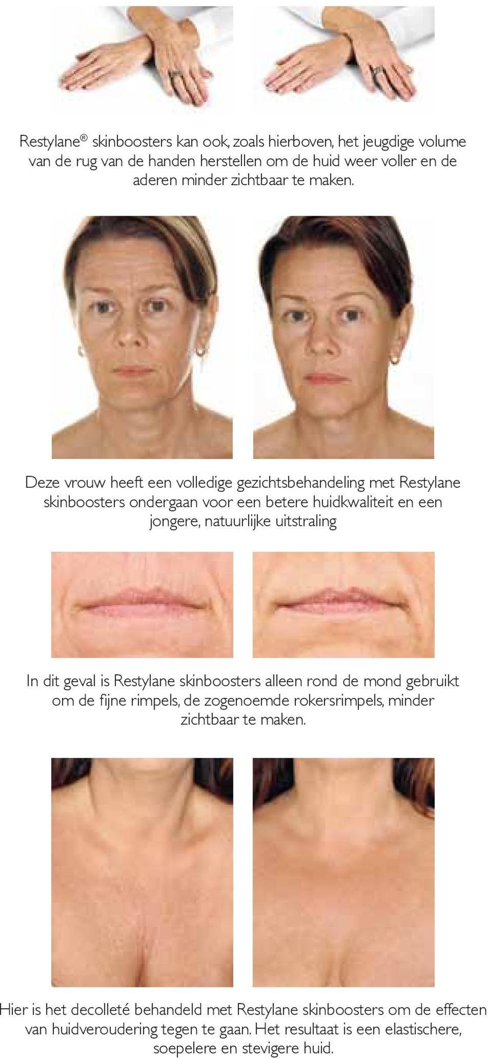 Deze vrouw heeft een volledige gezichtsbehandeling met Restylane skinboosters ondergaan voor een betere huidkwaliteit en een jongere, natuurlijke uitstraling In