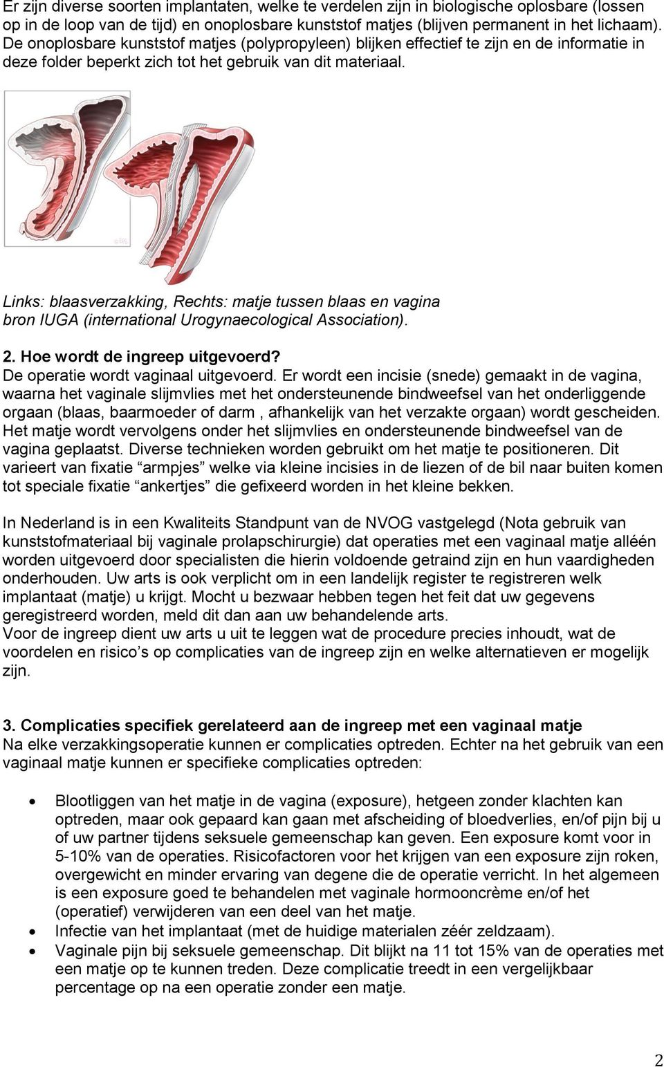 Links: blaasverzakking, Rechts: matje tussen blaas en vagina bron IUGA (international Urogynaecological Association). 2. Hoe wordt de ingreep uitgevoerd? De operatie wordt vaginaal uitgevoerd.