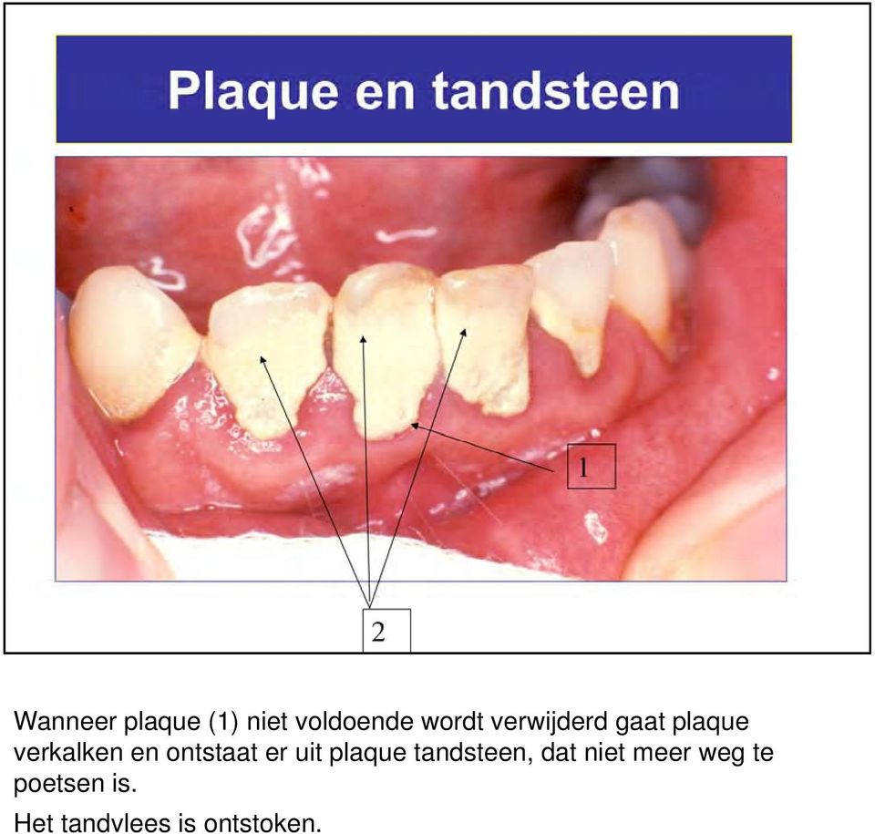 ontstaat er uit plaque tandsteen, dat niet