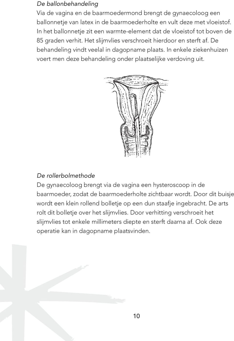 In enkele ziekenhuizen voert men deze behandeling onder plaatselijke verdoving uit.