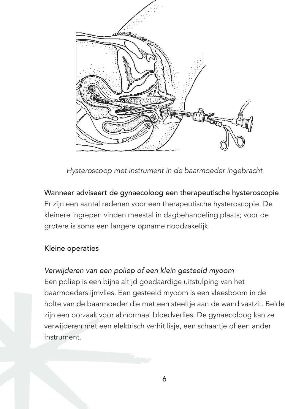 Kleine operaties Verwijderen van een poliep of een klein gesteeld myoom Een poliep is een bijna altijd goedaardige uitstulping van het baarmoederslijmvlies.