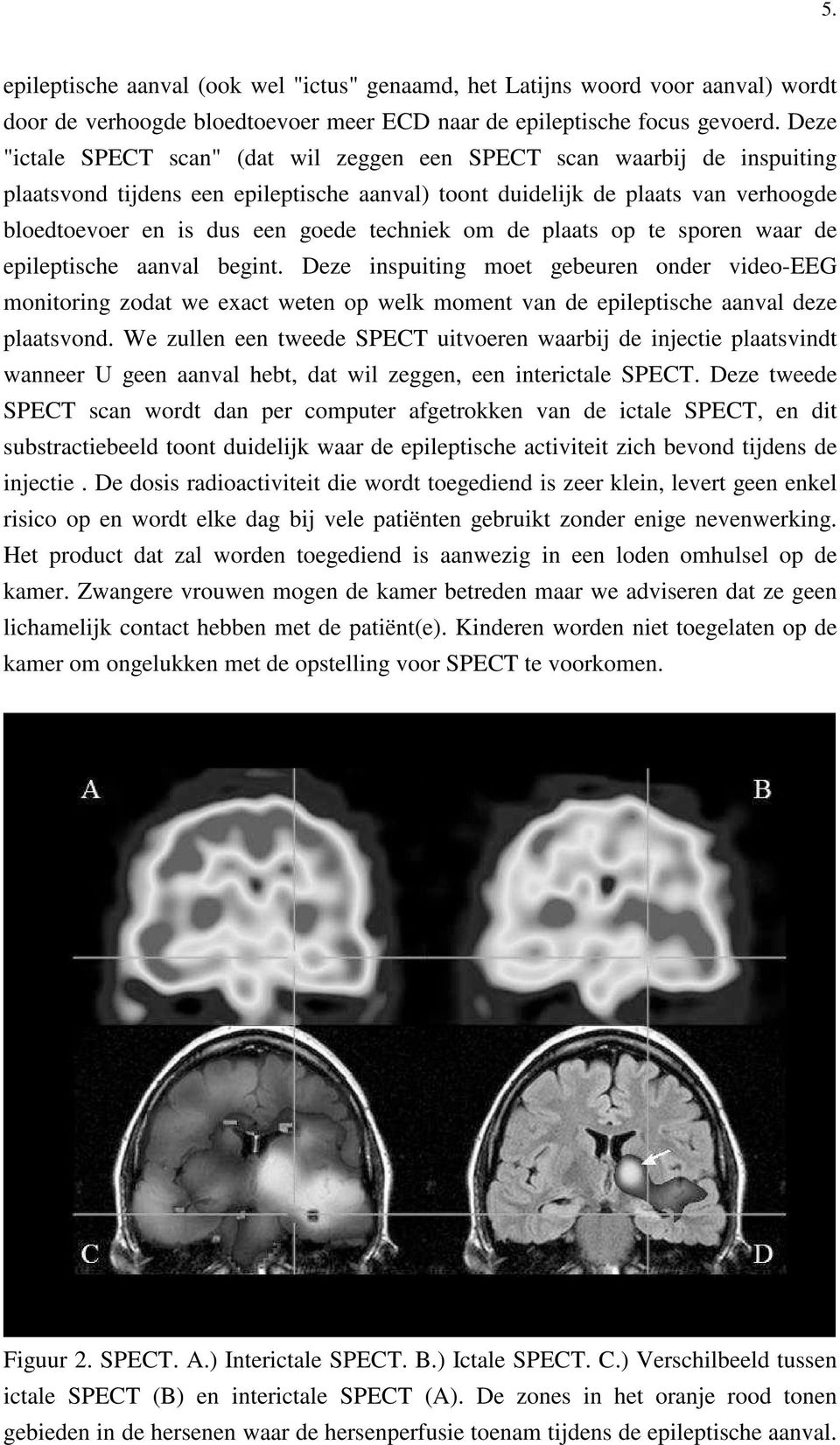 techniek om de plaats op te sporen waar de epileptische aanval begint.