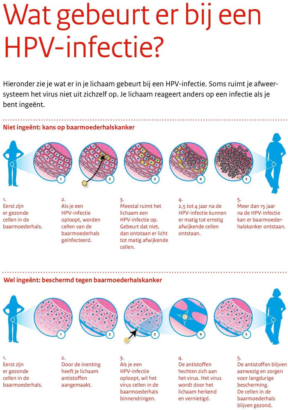 3. Meestal ruimt het lichaam een HPV-infectie op. Gebeurt dat niet, dan ontstaan er licht tot matig afwijkende cellen. 4.