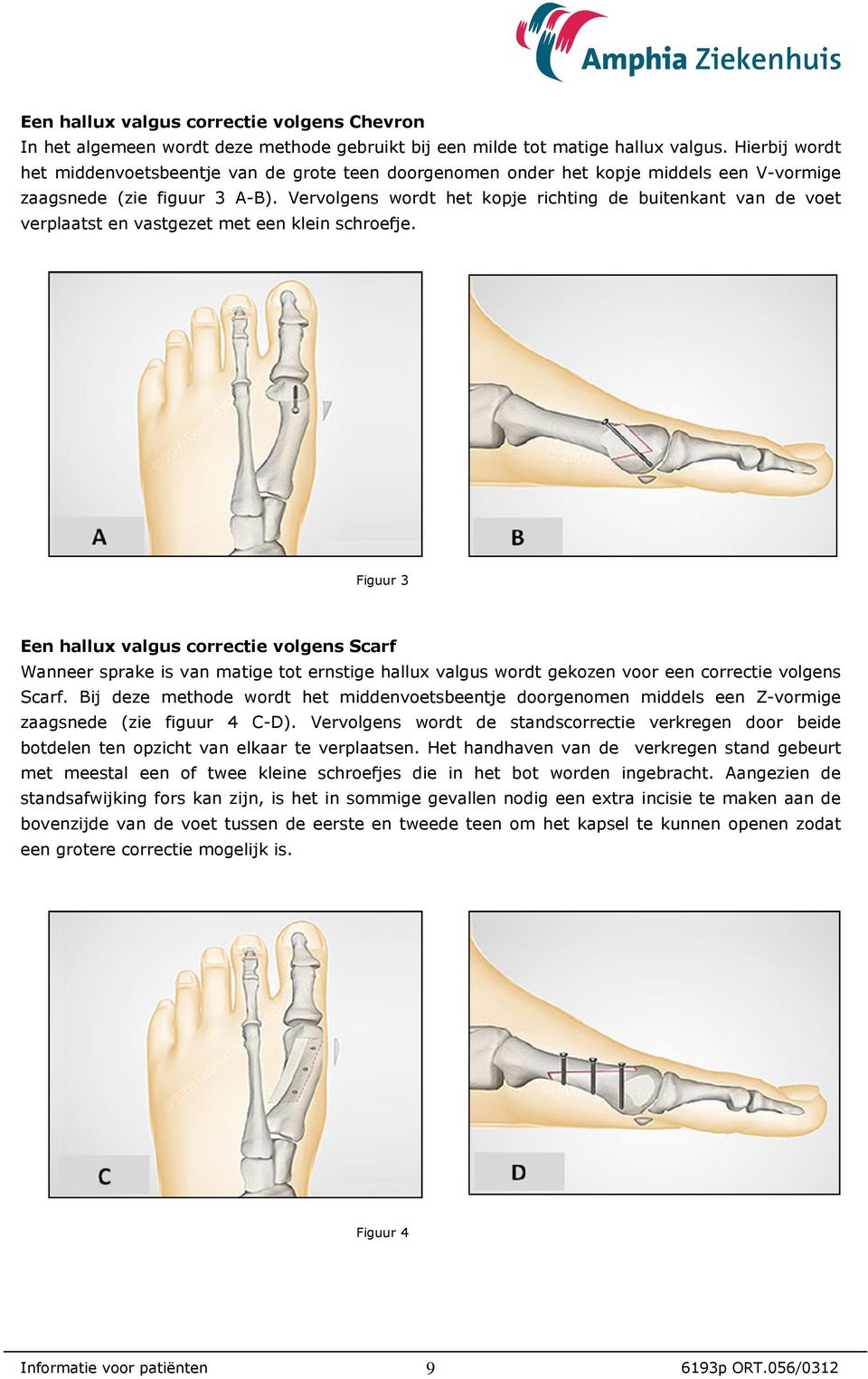 Vervolgens wordt het kopje richting de buitenkant van de voet verplaatst en vastgezet met een klein schroefje.