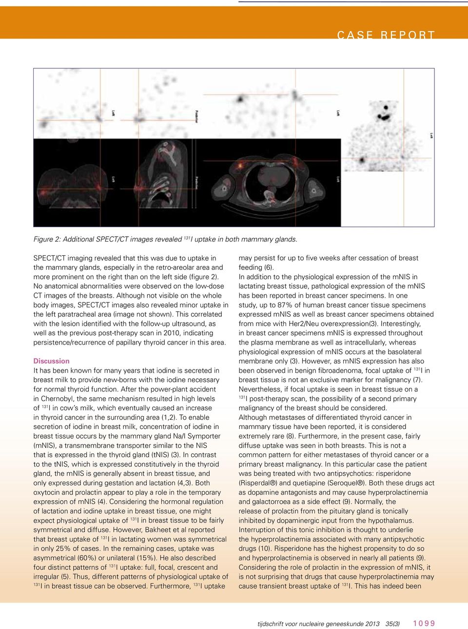 No anatomical abnormalities were observed on the low-dose CT images of the breasts.