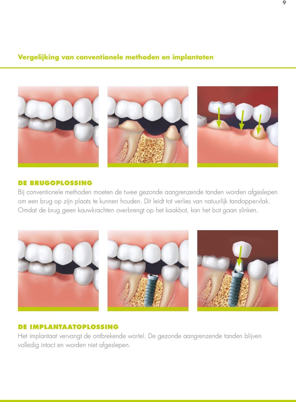 Dit leidt tot verlies van natuurlijk tandoppervlak.