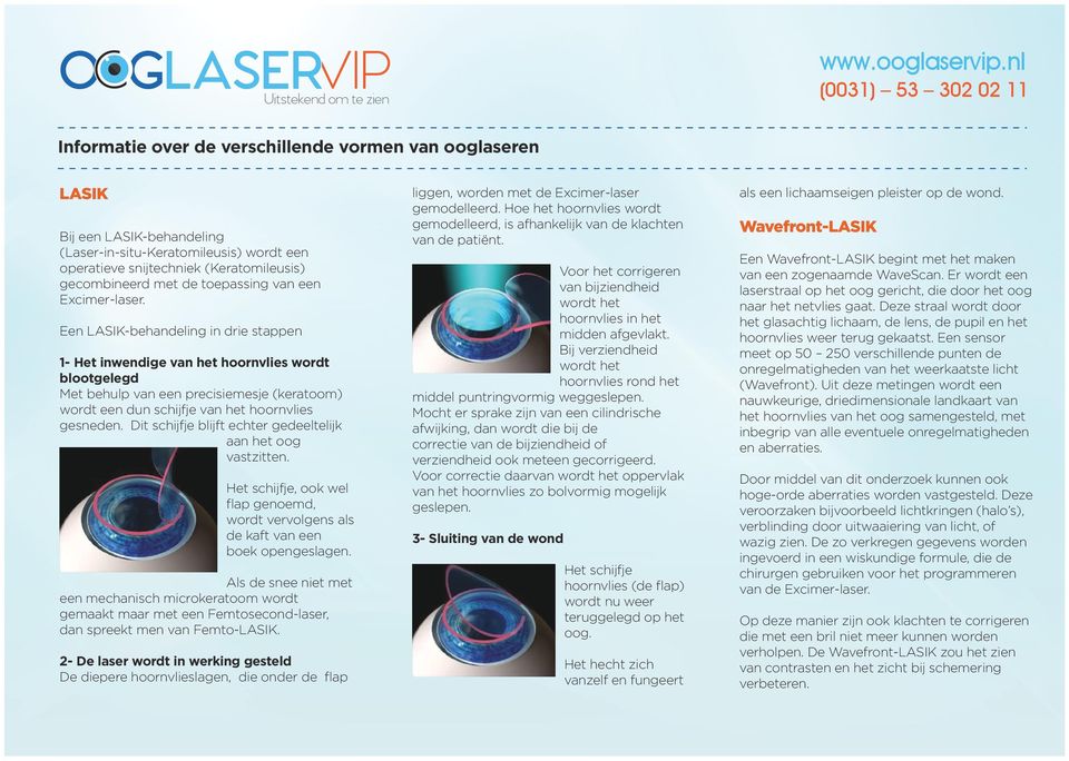 Een LASIK-behandeling in drie stappen 1- Het inwendige van het hoornvlies wordt blootgelegd Met behulp van een precisiemesje (keratoom) wordt een dun schijfje van het hoornvlies gesneden.