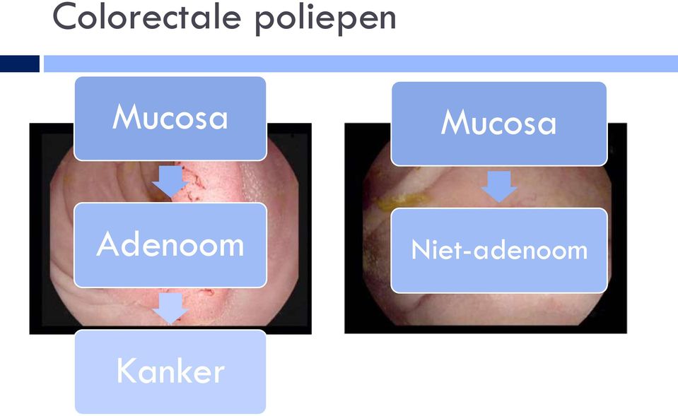 Mucosa Adenoom