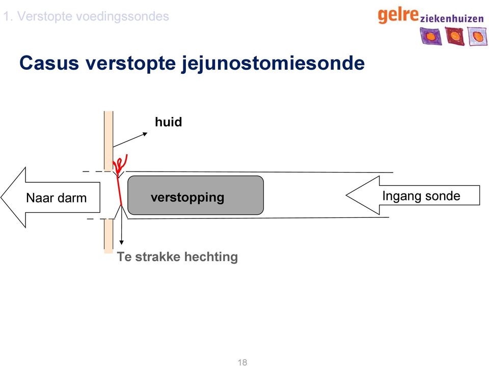 jejunostomiesonde huid Naar