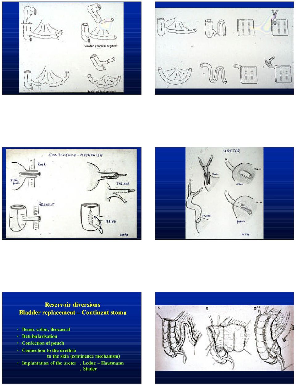 pouch Connection to the urethra to the skin (continence