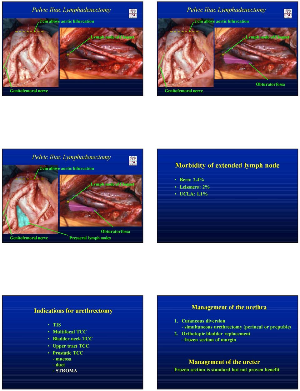 1% Genitofemoral nerve Obturatorfossa Presacral lymph nodes Indications for urethrectomy TIS Multifocal TCC Bladder neck TCC Upper tract TCC Prostatic TCC - mucosa - duct - STROMA Management of