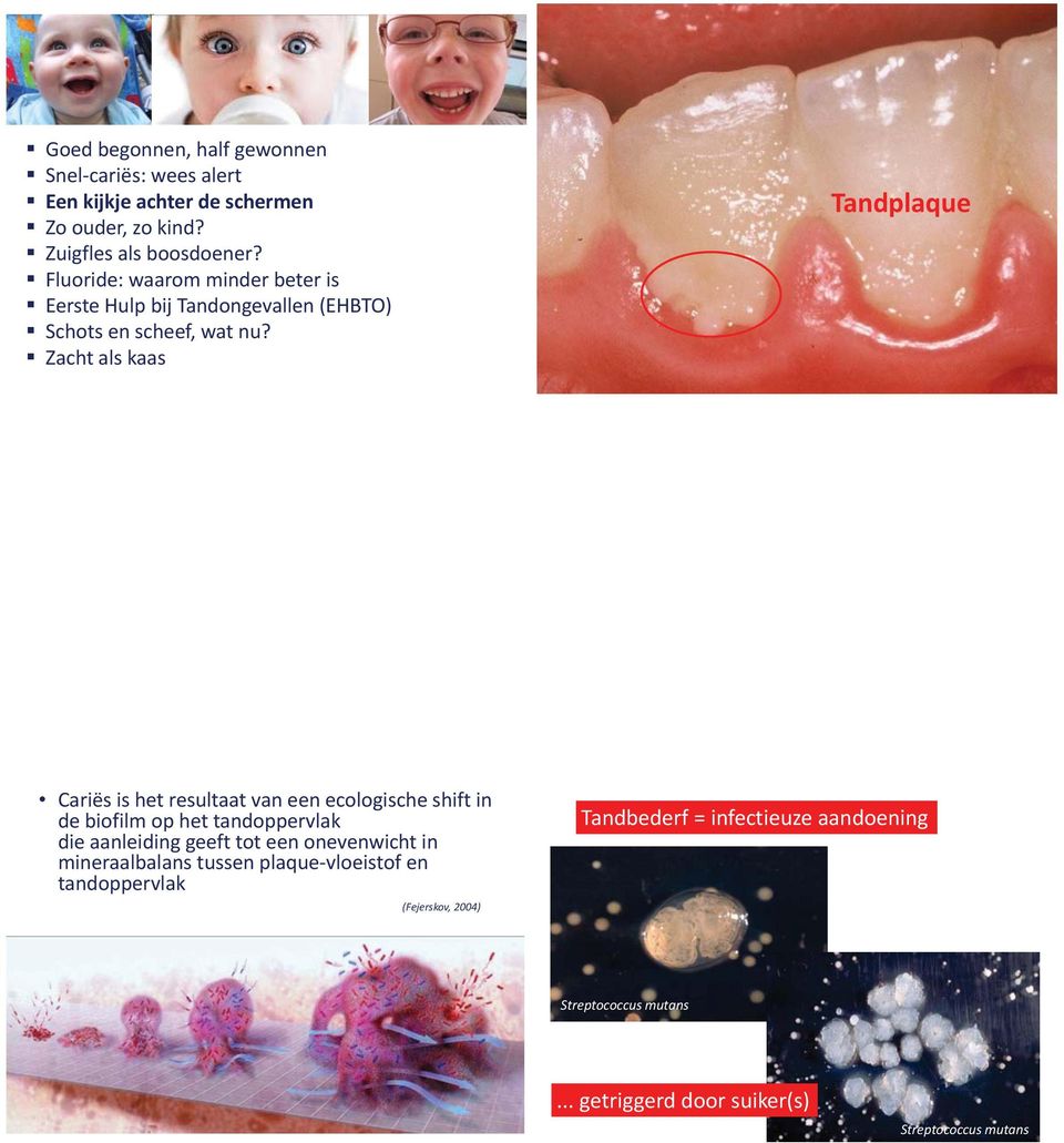 Zacht als kaas Tandplaque Cariës is het resultaat van een ecologische shift in de biofilm op het tandoppervlak die aanleiding geeft tot een