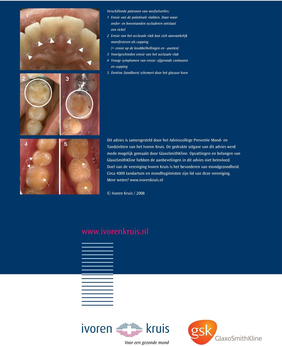 Voortgeschreden erosie van het occlusale vlak 4 Vroege symptomen van erosie: afgeronde contouren en cupping 5 Dentine (tandbeen) schemert door het glazuur heen Dit advies is samengesteld door het