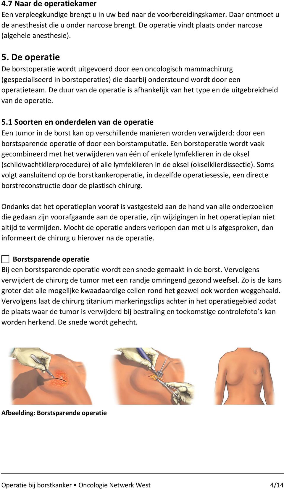 De operatie De borstoperatie wordt uitgevoerd door een oncologisch mammachirurg (gespecialiseerd in borstoperaties) die daarbij ondersteund wordt door een operatieteam.