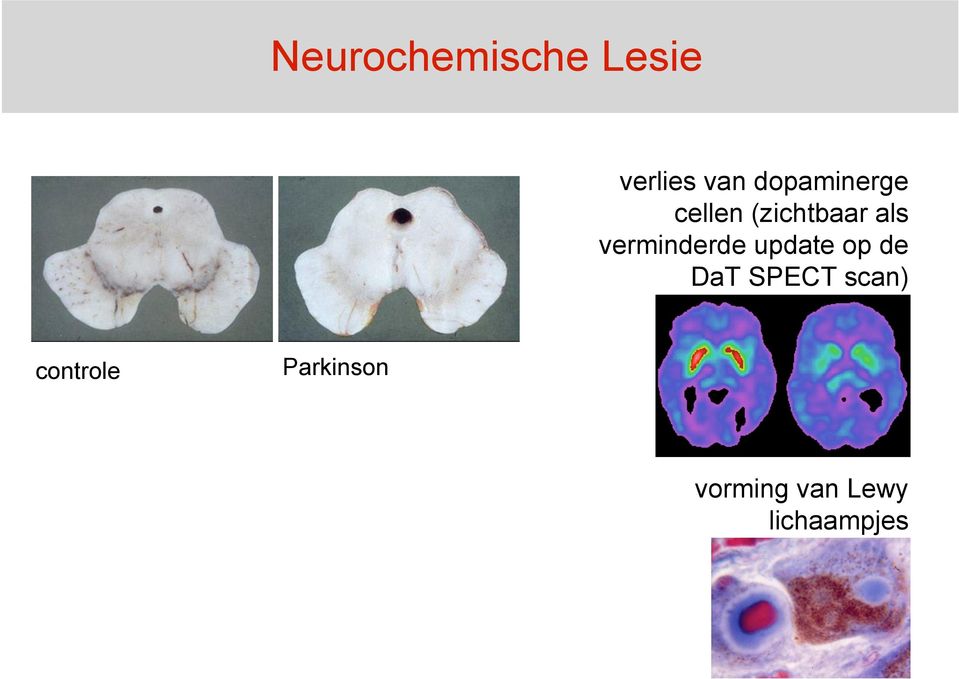 verminderde update op de DaT SPECT