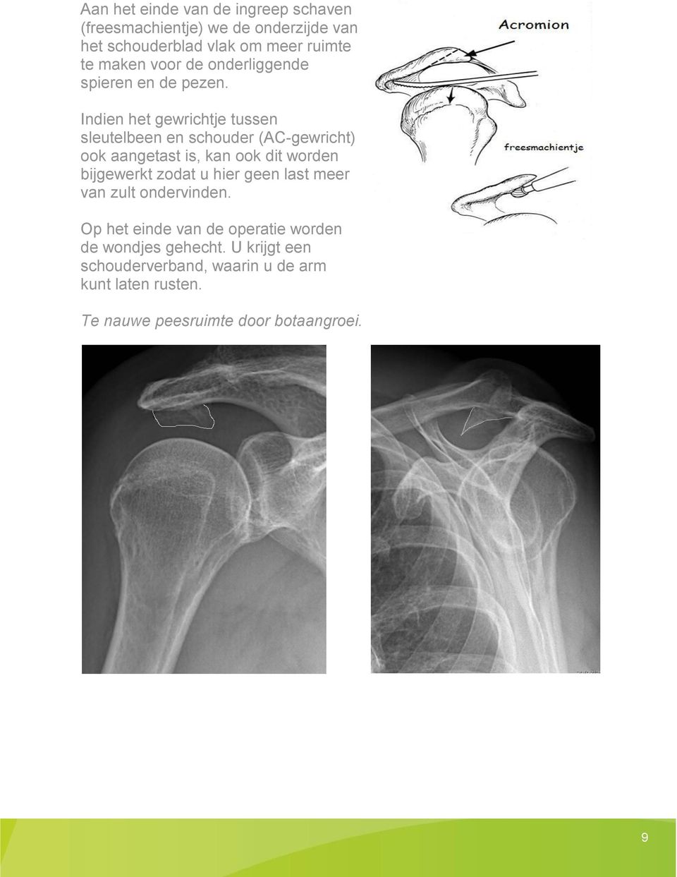Indien het gewrichtje tussen sleutelbeen en schouder (AC-gewricht) ook aangetast is, kan ook dit worden bijgewerkt zodat u
