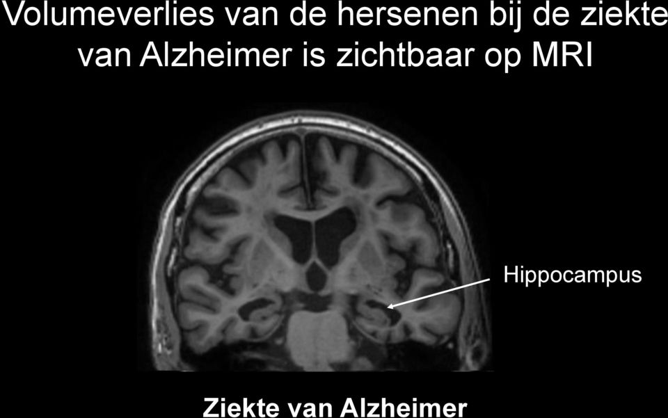 is zichtbaar op MRI