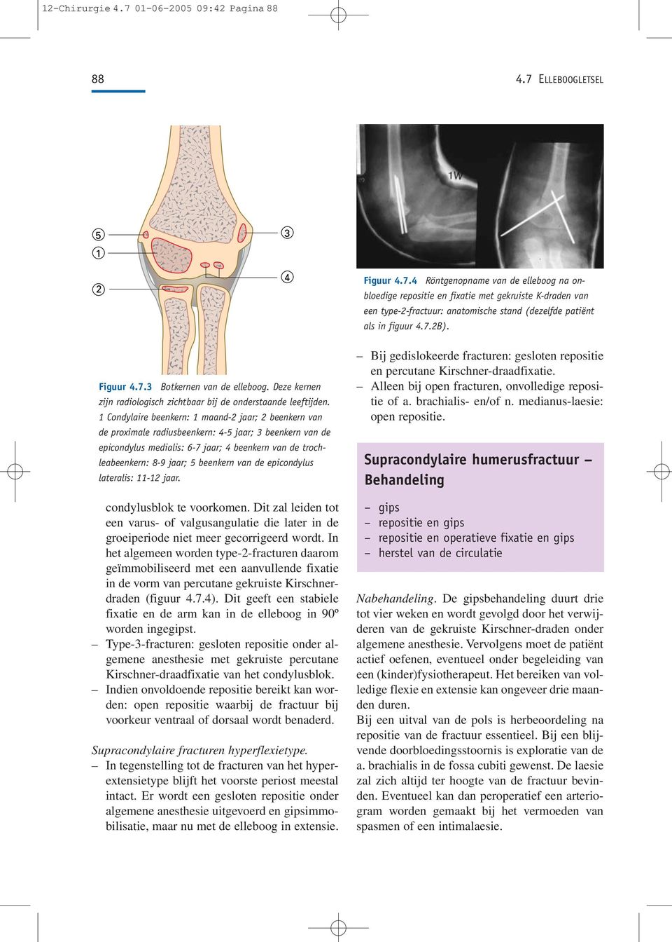 1 Condylaire beenkern: 1 maand-2 jaar; 2 beenkern van de proximale radiusbeenkern: 4-5 jaar; 3 beenkern van de epicondylus medialis: 6-7 jaar; 4 beenkern van de trochleabeenkern: 8-9 jaar; 5 beenkern