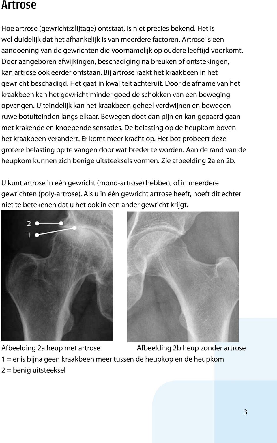 Bij artrose raakt het kraakbeen in het gewricht beschadigd. Het gaat in kwaliteit achteruit. Door de afname van het kraakbeen kan het gewricht minder goed de schokken van een beweging opvangen.