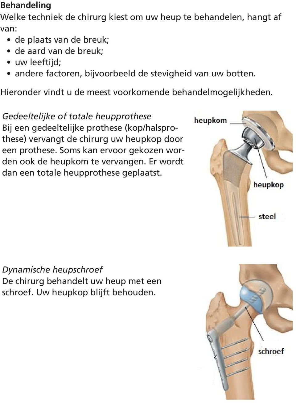 Gedeeltelijke of totale heupprothese Bij een gedeeltelijke prothese (kop/halsprothese) vervangt de chirurg uw heupkop door een prothese.