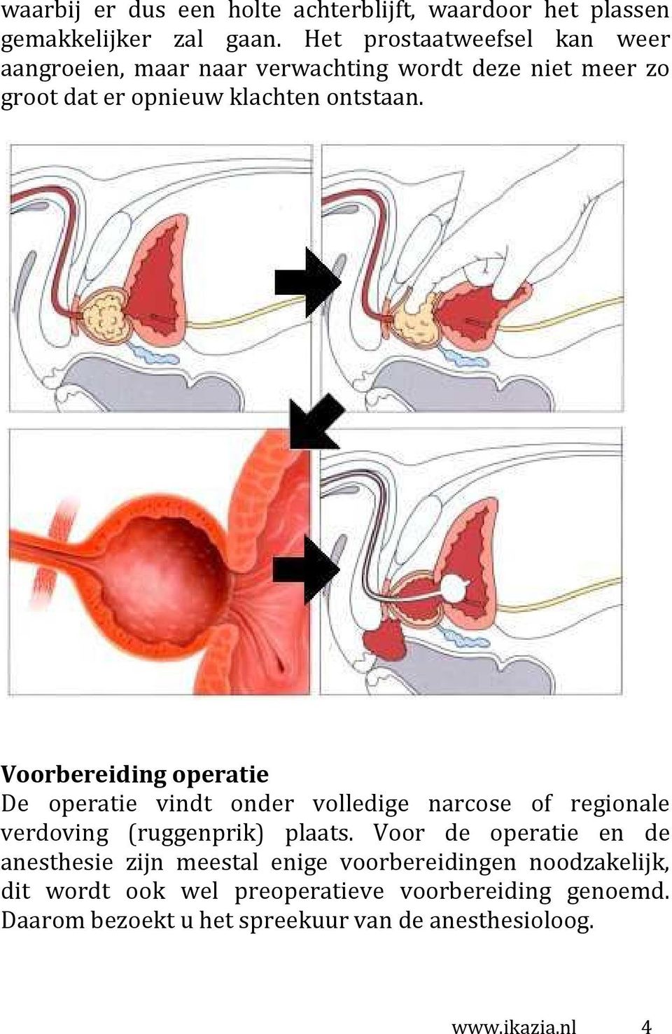 Voorbereiding operatie De operatie vindt onder volledige narcose of regionale verdoving (ruggenprik) plaats.